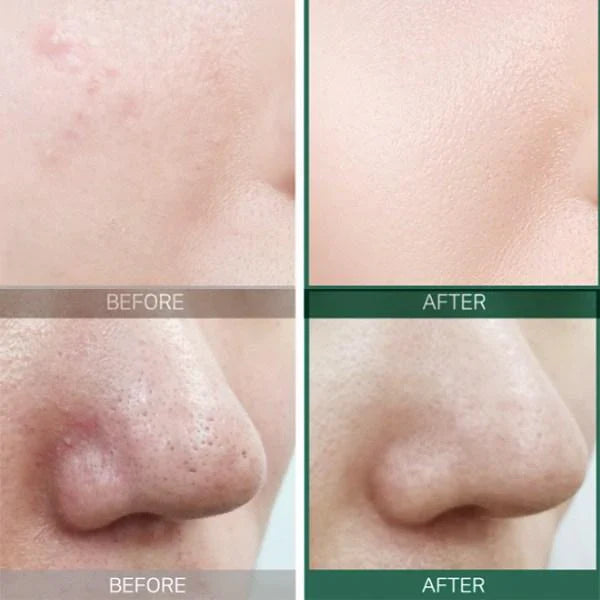 SOME BY MI AHA BHA PHA 30 Days Miracle Starter Kit